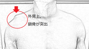 肩鎖関節突出図 肩鎖関節突出図