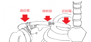 鎖骨骨折1 鎖骨骨折1
